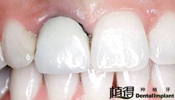牙床萎缩