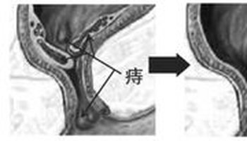 痔疮核根据其发病部位不同分为内痔,外痔,混合痔三类,内痔的痔块位于