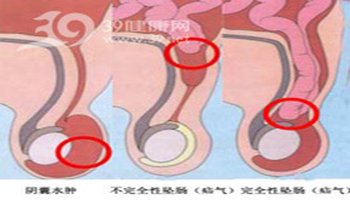 藏毛窦