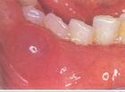 粘液腺囊肿是口腔常见病,其表现为口腔粘膜下小的透明小泡状肿物,无