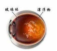 患者眼前会出现黑点,并且会随着眼球的转动而飞来飞去,好像飞蚊一般