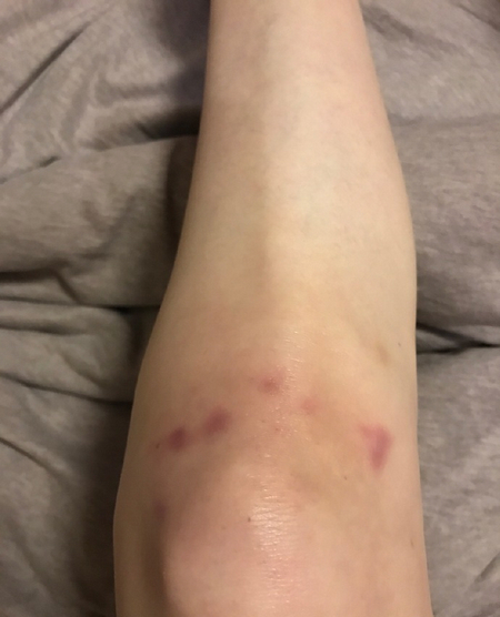 受伤的照片,照片中周丽淇的手部呈紫黑色,看起来伤的不轻,膝盖也有几