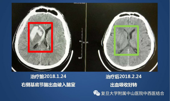 钱宇平恢复良好，今日转院进行康复治疗