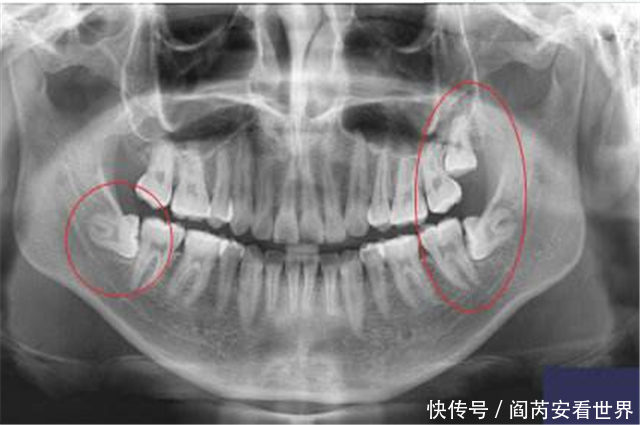 为什么被拔出来的智齿味道很重?听完医生的