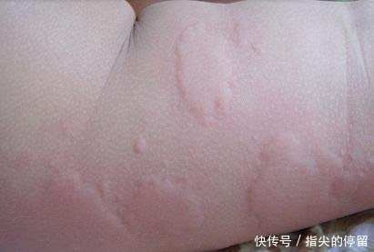荨麻疹止痒小妙招有哪些 这六个止痒方法帮你