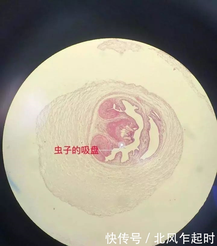 头皮发麻!31岁女子手臂鼓起一个包,切开一看有
