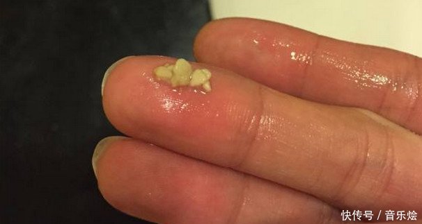 7岁小孩因嘴里异味太重被同学耻笑,检查后拿出