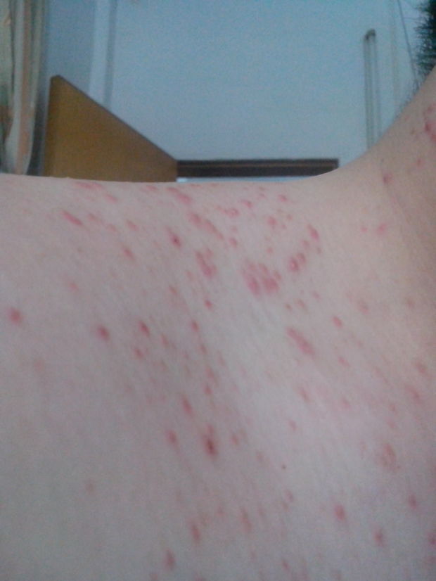 有谁知道我的脸上和脖子上的这些痘痘是怎么一