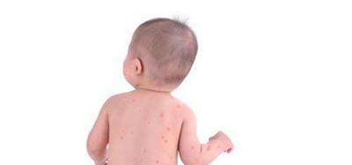 小孩出水痘发烧怎么办出水痘发烧能吃退烧药吗