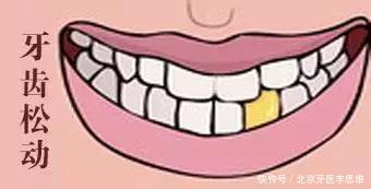 牙齿松动的4个原因