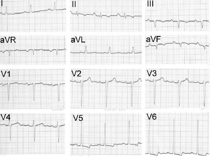 一文纵览:8种心肌病的心电图表现