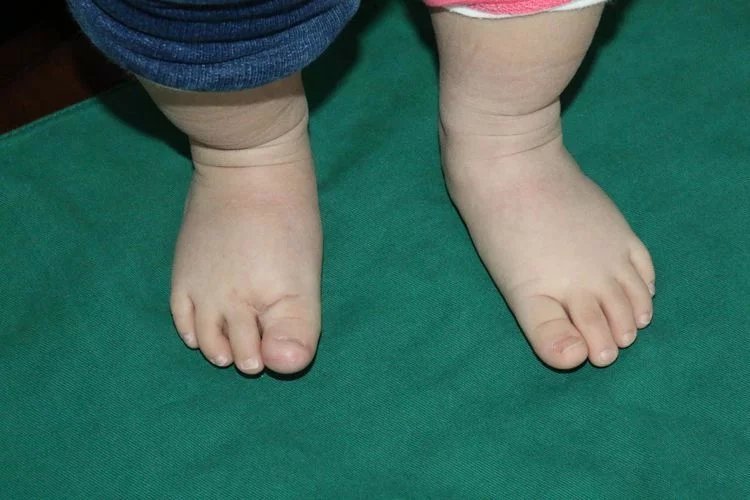4岁女孩穿38号大鞋,都是巨趾症惹的祸!