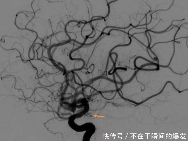 女子洗澡时突发脑出血,她第一时间做了这件事