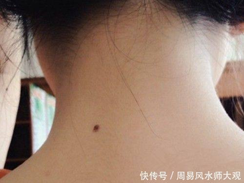 后背长痣看运势,不同位置运势大不同,你的身上有没有?