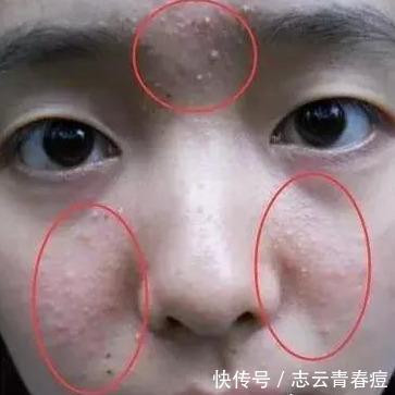 脸上长痘和螨虫感染有关系吗?