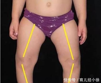 宝妈太无知,害的宝宝O型腿!