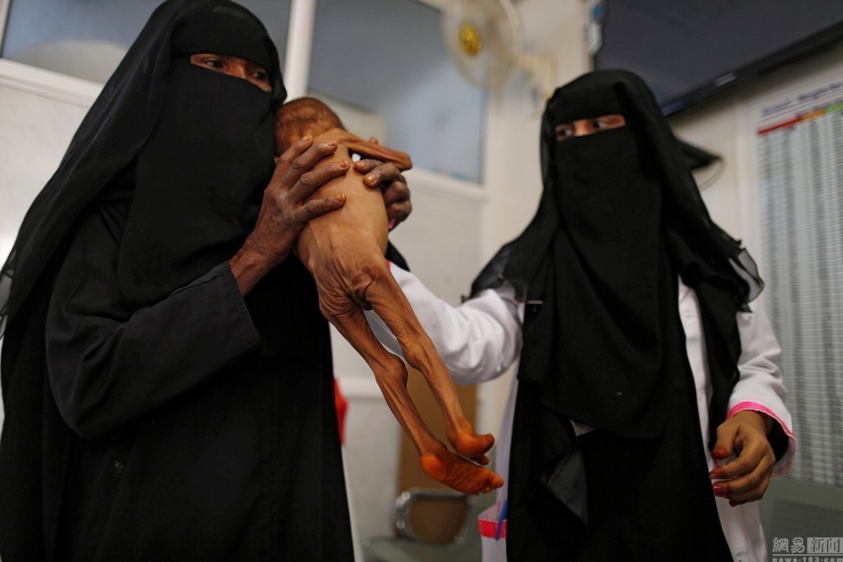 也门战事持续 儿童瘦成"皮包骨"