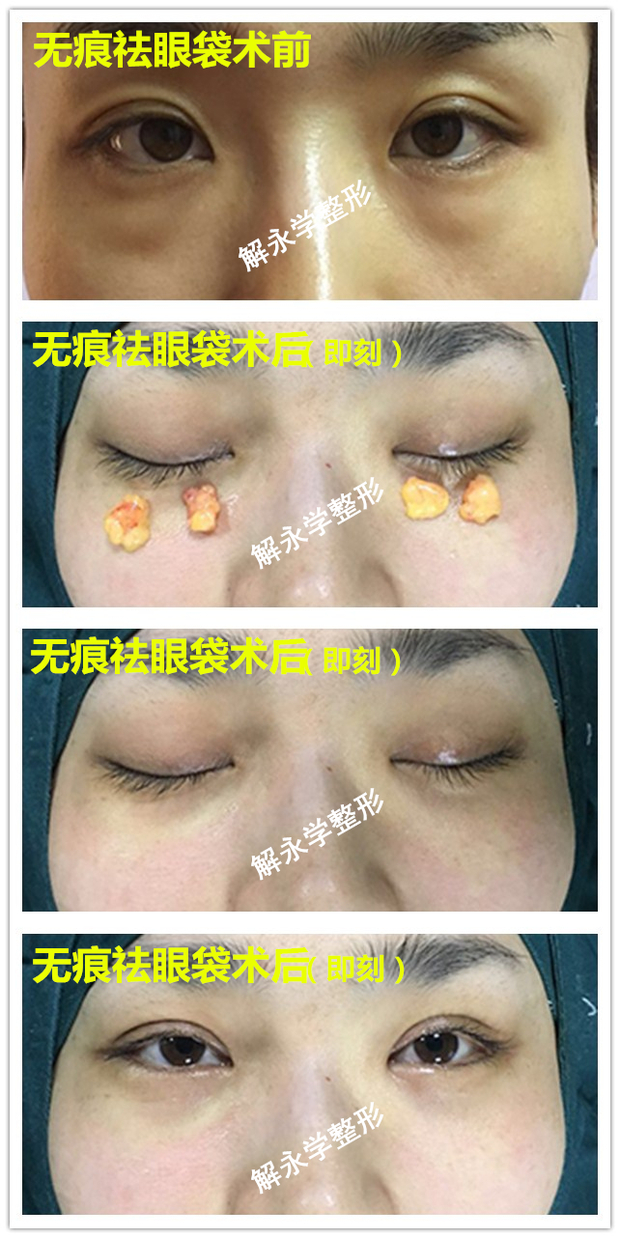 珠海做个去除眼袋的手术到哪家医院进行好,费