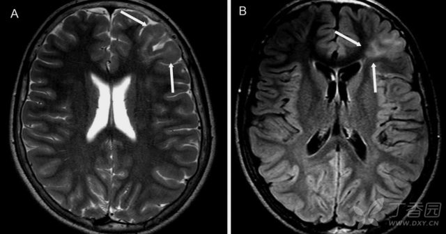 症状性癫痫常见 6 大病因的影像学表现