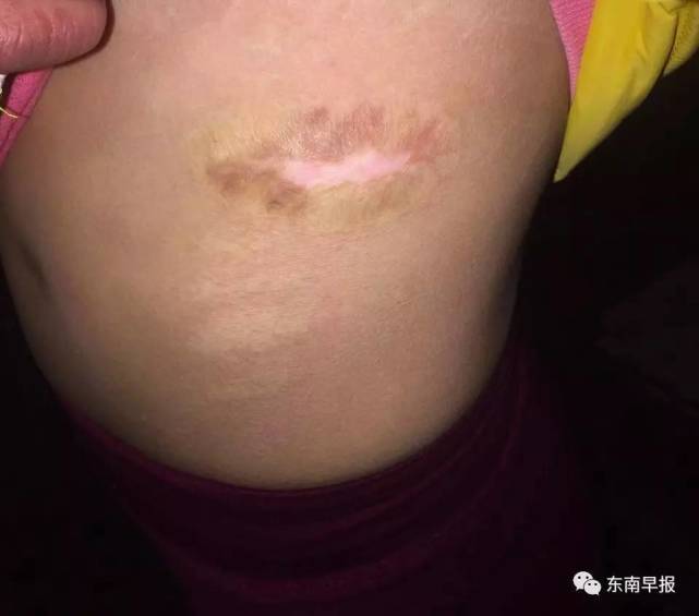 【转】北京时间 12岁女童遭亲妈家暴:手指被剪断身体被烫伤 - 妙康居士 - 妙康居士~晴樵雪读的博客 【转】北京时间 12岁女童遭亲妈家暴:手指被剪断身体被烫伤 - 妙康居士 - 妙康居士~晴樵雪读的博客