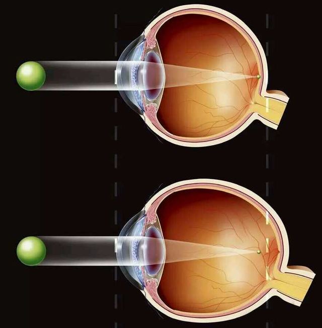 从近视800度到视力1.0,你应该这么做