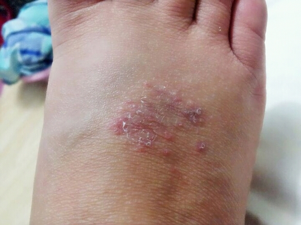 脚上长了一层小红疹,是在抓挠之后长出来的,而且很长时间不消下去
