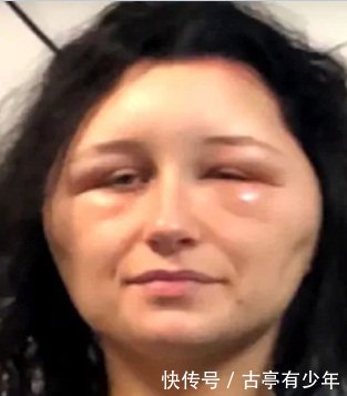19岁的美女染染发剂几乎致命的过敏反应,导致
