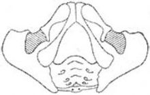 结节间径<8cm,坐骨结节间径与后矢状径之和<15cm,耻骨弓角<