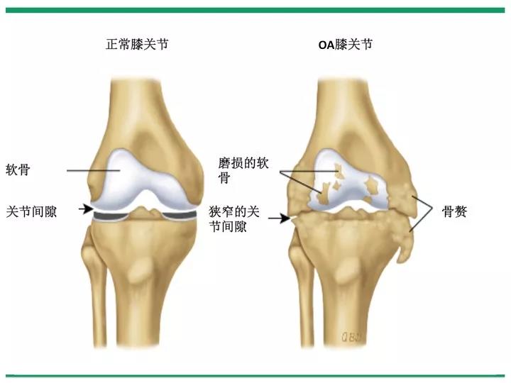 骨关节炎的非药物治疗