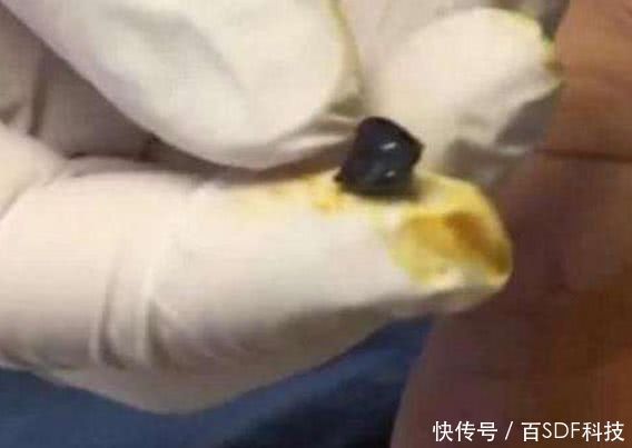 男子下河后发现脚上的黑疙瘩，经检查后医生的话让他后怕