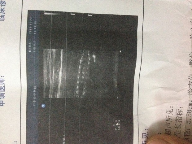 22周胎儿脊椎非正常的 图片_360问答