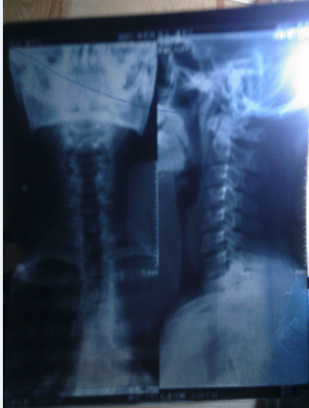 颈椎病后脑勺持续晕麻有时还会疼.一天到晚一