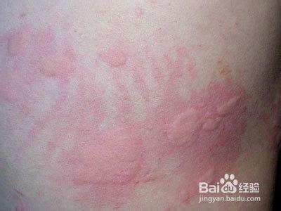 小儿荨麻疹是一种常见的过敏性皮肤病,在接触过敏原的时候,会在身体