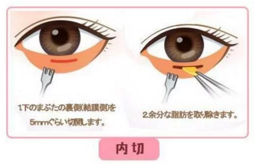 年纪轻轻就有眼袋是什么样的一个体验?没了墨