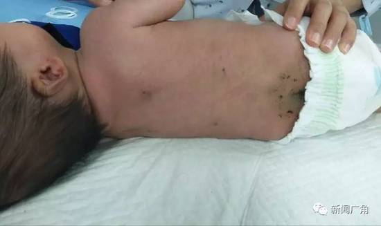 【转】北京时间 外婆信土方找人放血 男婴被扎30多针 - 妙康居士 - 妙康居士~晴樵雪读的博客 【转】北京时间 外婆信土方找人放血 男婴被扎30多针 - 妙康居士 - 妙康居士~晴樵雪读的博客
