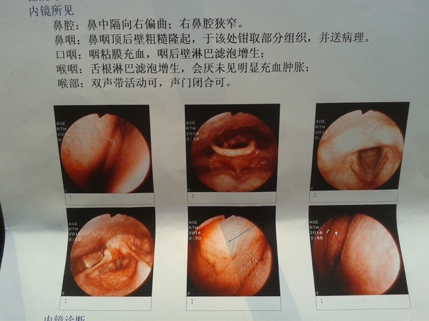 鼻咽顶后壁粗糙隆起需要做手术吗?如果做手术有什么后