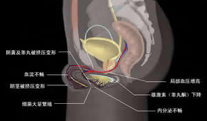 拖延时间越长,睾丸丧失功能的可能性就越大,到时即使睾丸不被切除,也