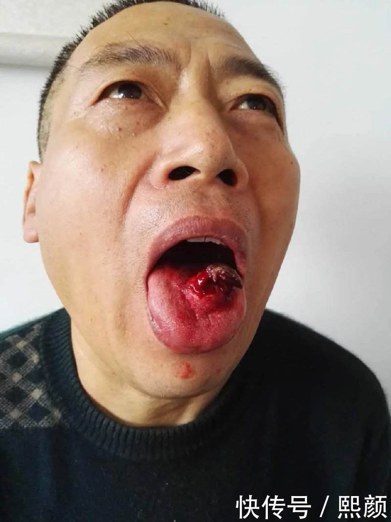 浙江丽水老人咬到舌头后一个月诱发癌症 喝酒