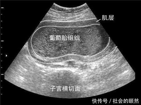 年轻女孩腹部隆起,如同怀孕7个月孕妇,检查之