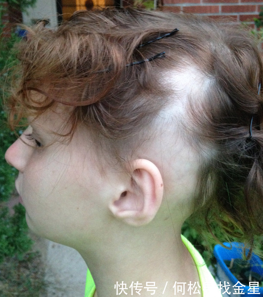 小女孩大量掉发以为患癌症,没想到罪魁祸首竟