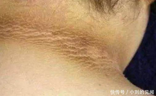 28岁男子脖子变黑洗不掉, 医院的检查结果, 让