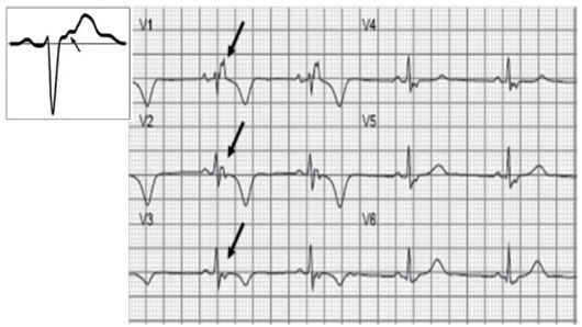 一文纵览:8种心肌病的心电图表现