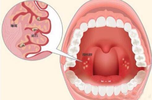 石萍:喉咙痛别不当回事 扁桃体炎不简单