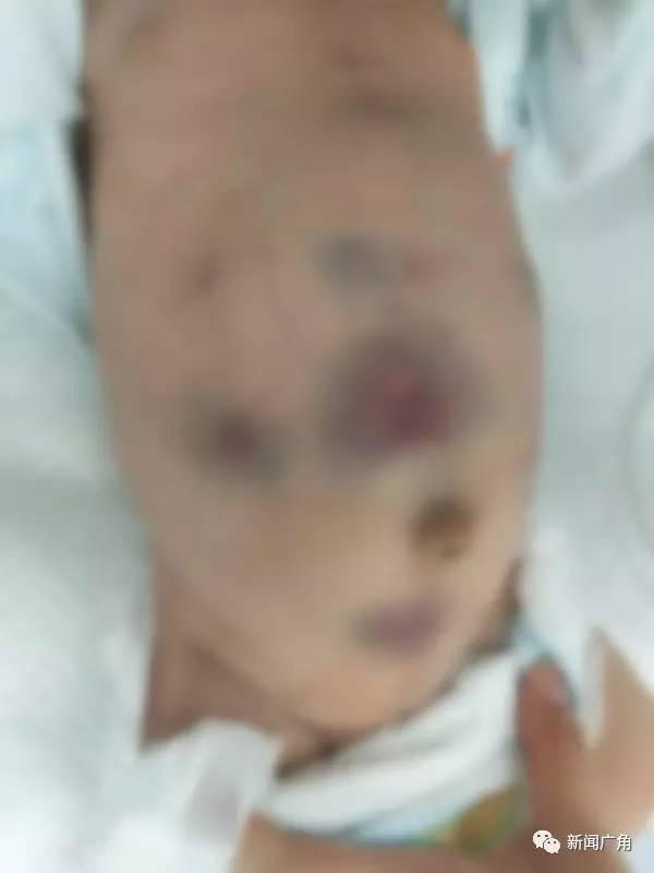 【转】北京时间 外婆信土方找人放血 男婴被扎30多针 - 妙康居士 - 妙康居士~晴樵雪读的博客 【转】北京时间 外婆信土方找人放血 男婴被扎30多针 - 妙康居士 - 妙康居士~晴樵雪读的博客