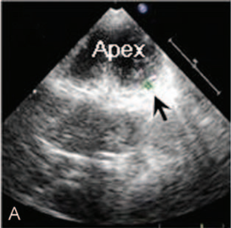 屋漏偏逢连夜雨，心肌致密化不全合并心肌桥