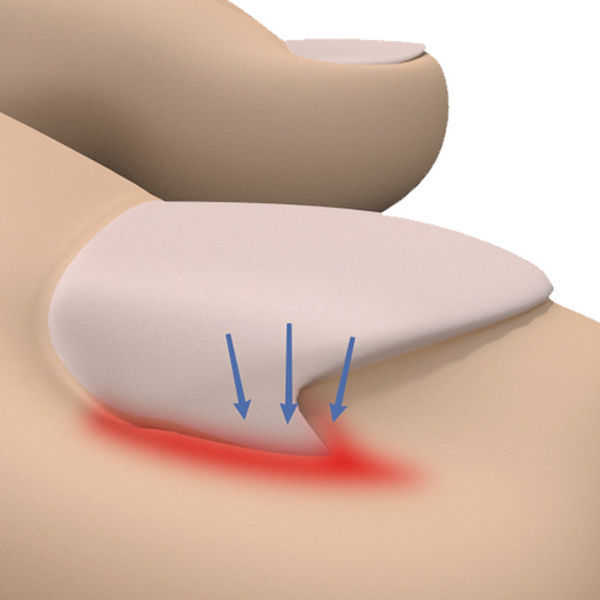 甲沟炎,拔指甲第三天了还是好疼,怎么办