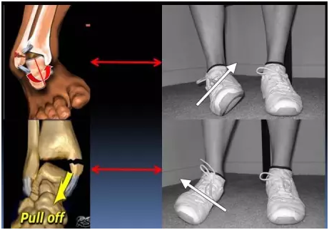 在足旋前状态时,踝关节内侧结构紧张,而旋后状态是外侧结构紧张(见上