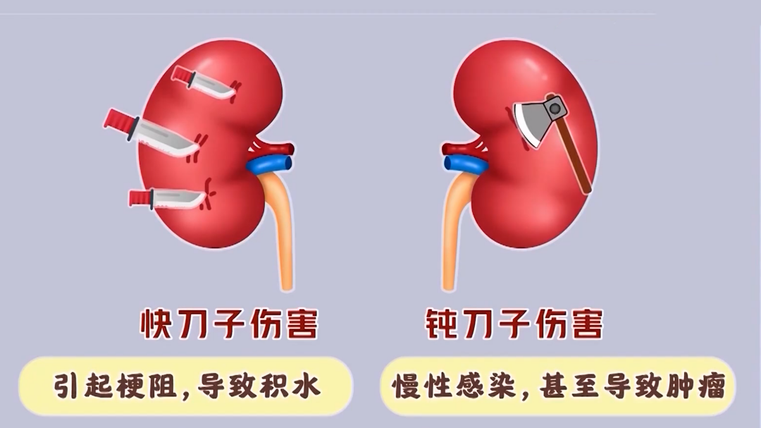 X诊所. 警惕身体里的石头“憋大招”