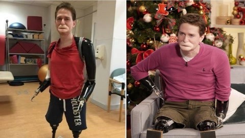 涨健识 男子遇食肉菌，四肢被截嘴唇消失像俩香肠