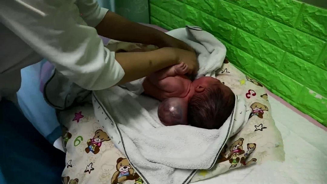 17天大男婴命悬一线